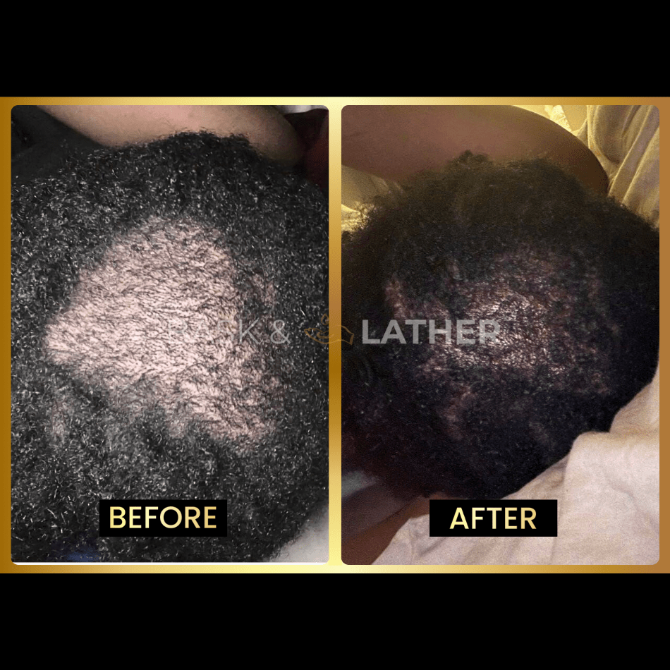 Scalp Stimulator - 3 Month Supply - Image 4