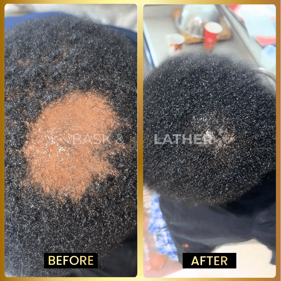 Scalp Stimulator - 3 Month Supply - Image 3
